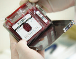 Pall 2 chamber cord blood storage bag