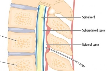 illustration of intrathecal injection for cell therapy