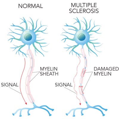 Diagram of how Multiple Sclerosis effects myelin sheaths around nerves