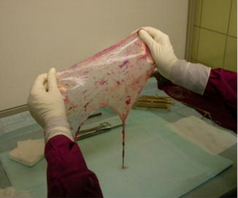 Gloved hands holding amniotic membrane