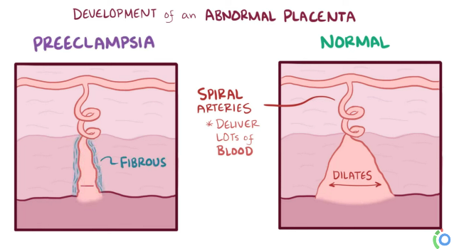 Osmosis.org Preeclampsia explainer video
