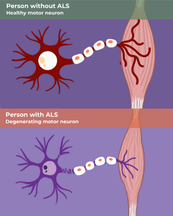 Image Credit: ALS News Today | ALS overview