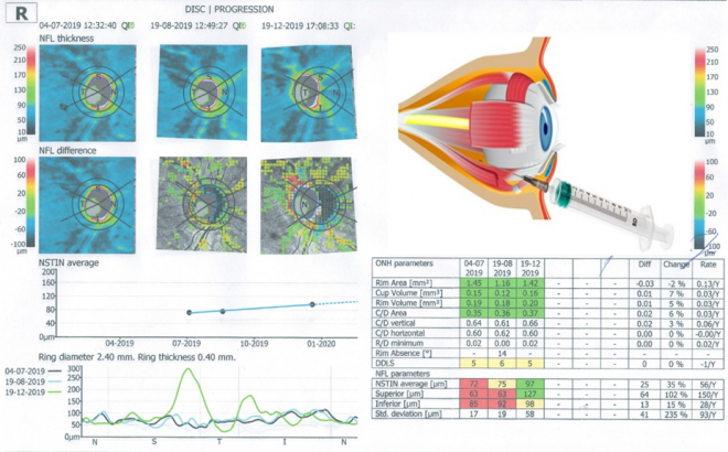 optical coherence tomography of Vladomir’s right eye.