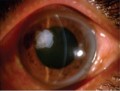 amniotic membrane as dressing for corneal perforation amniotic membrane as dressing for corneal perforation